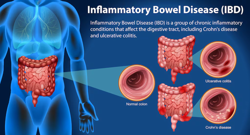 Iranian Consensus Guideline for Pharmacotherapy with Biologics and Small Molecules Drugs in Adults with Inflammatory Bowel Diseases